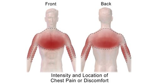 Complications of Atherosclerosis