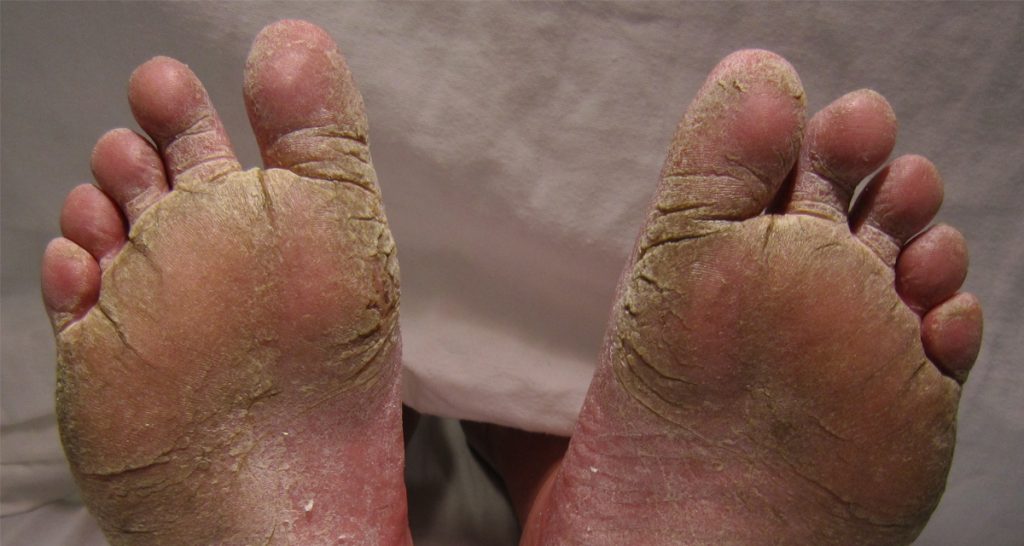 Complications of Athlete’s Foot