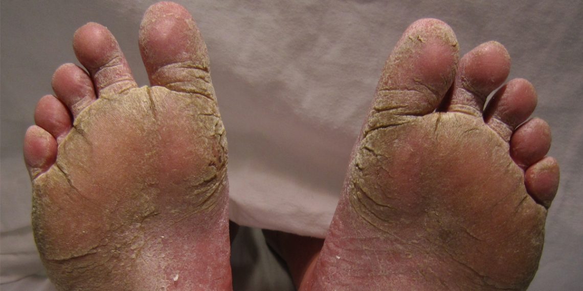 Complications of Athlete’s Foot