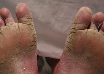 Complications of Athlete’s Foot