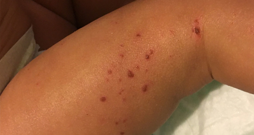 Complications of Atopic Eczema