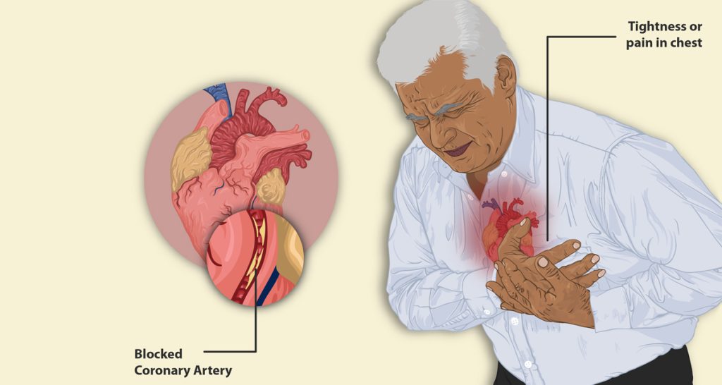 Complications of Atrial Fibrillation