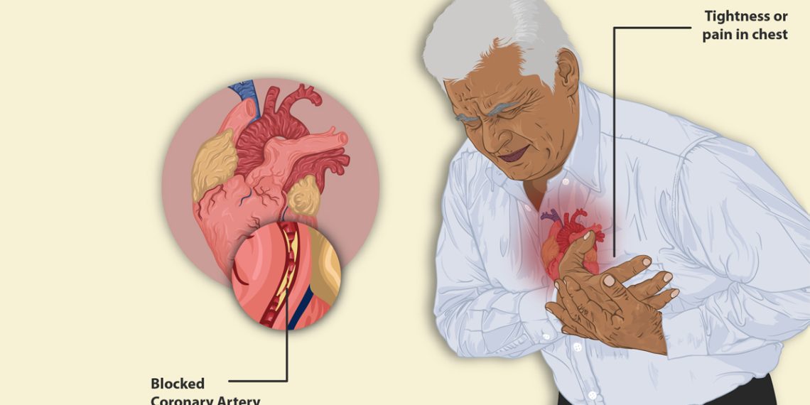 Complications of Atrial Fibrillation