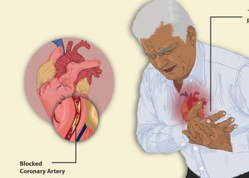 Complications of Atrial Fibrillation