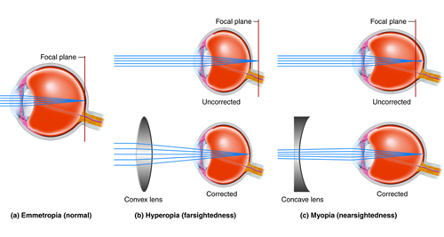 Complications of Untreated Astigmatism