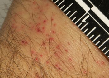 Diagnosis and Detection of Bedbugs in the Home