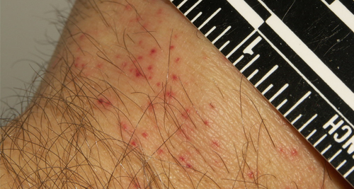 Diagnosis and Detection of Bedbugs in the Home