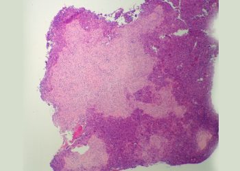 Microscopic image showing a bone cyst under histological evaluation with varying shades of pink and purple.