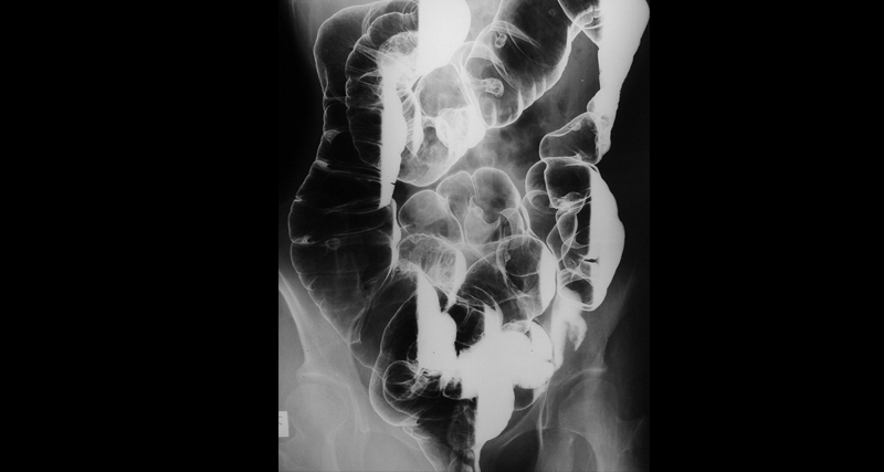 Barium enema X-ray showing contrast-filled colon for bowel polyp evaluation