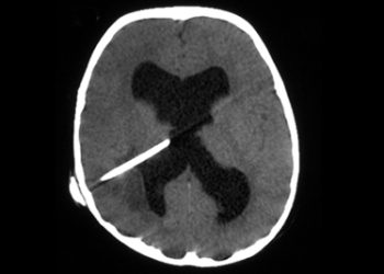 CT scan showing needle aspiration during diagnosis of brain abscess