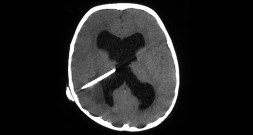 CT scan showing needle aspiration during diagnosis of brain abscess