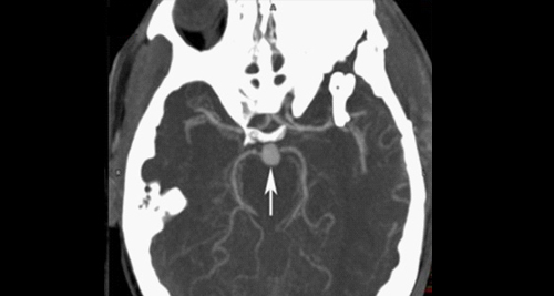 Diagnosis and Evaluation of Brain Aneurysm