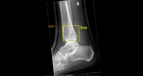 Diagnosis and Evaluation of Broken Ankle
