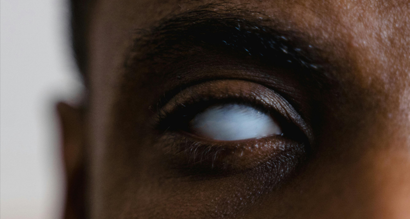 Close-up of a person’s eye showing signs of severe vision impairment or blindness.