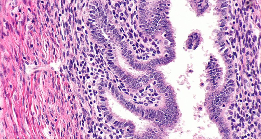 Diagnosis and Medical Imaging of Adenomyosis