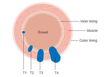 Diagnosis and Screening for Bowel Cancer