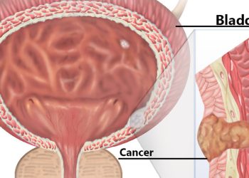 Medical illustration of bladder cancer showing tumour growth and bladder wall cross-section used in diagnosis and staging.