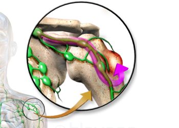 Illustration of bone cancer with lymphatic spread and anatomical highlighting of affected bone and lymph nodes.