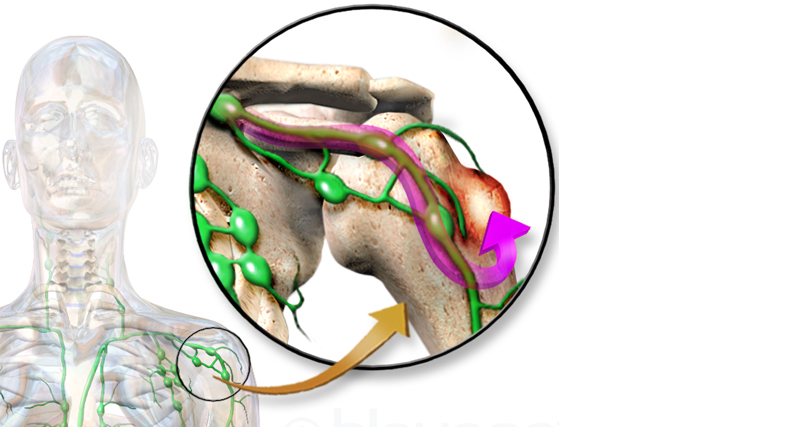 Illustration of bone cancer with lymphatic spread and anatomical highlighting of affected bone and lymph nodes.