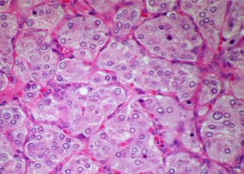 Microscopic view of bladder tissue cells, often used in diagnostic tests for bladder pain syndrome.