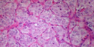 Microscopic view of bladder tissue cells, often used in diagnostic tests for bladder pain syndrome.