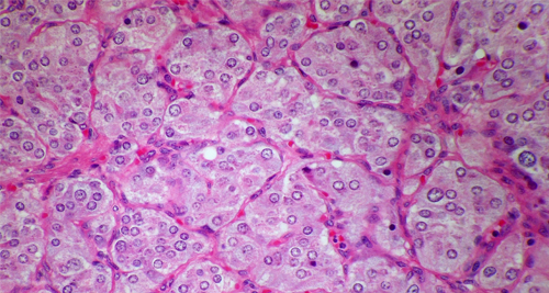Microscopic view of bladder tissue cells, often used in diagnostic tests for bladder pain syndrome.
