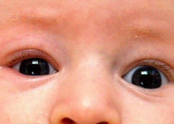Close-up of a baby’s eyes showing early signs of blepharitis, including redness and swollen eyelids.