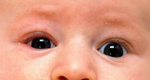 Close-up of a baby’s eyes showing early signs of blepharitis, including redness and swollen eyelids.