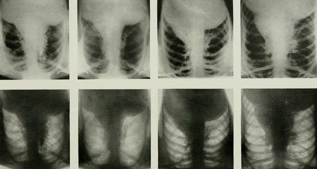 Diagnosis and Treatment of Actinomycosis