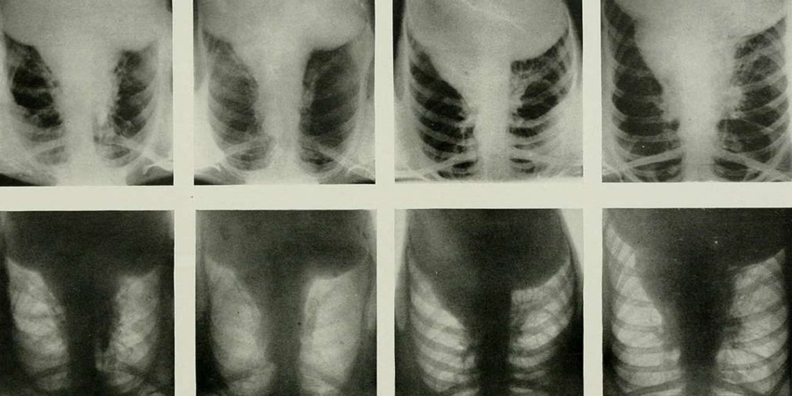 Diagnosis and Treatment of Actinomycosis