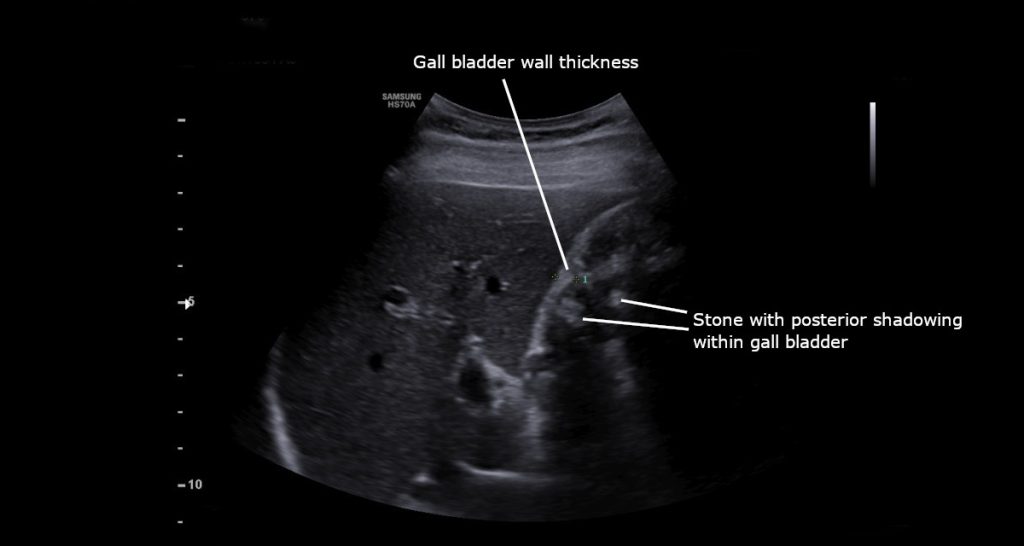 Diagnosis and Treatment of Acute Cholecystitis