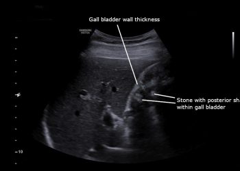 Diagnosis and Treatment of Acute Cholecystitis