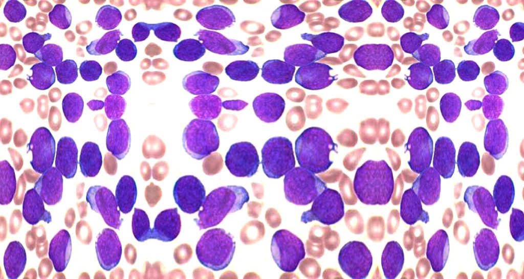 Diagnosis and Treatment of Acute Lymphoblastic Leukaemia