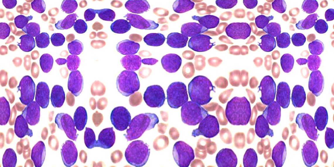 Diagnosis and Treatment of Acute Lymphoblastic Leukaemia