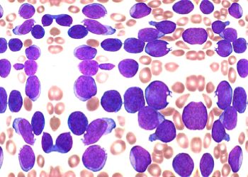 Diagnosis and Treatment of Acute Lymphoblastic Leukaemia