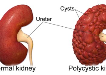 Comparison of a normal kidney and a polycystic kidney with labelled cysts and ureter.