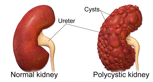 Comparison of a normal kidney and a polycystic kidney with labelled cysts and ureter.