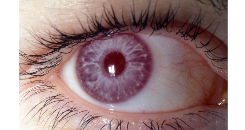 Diagnosis of Albinism