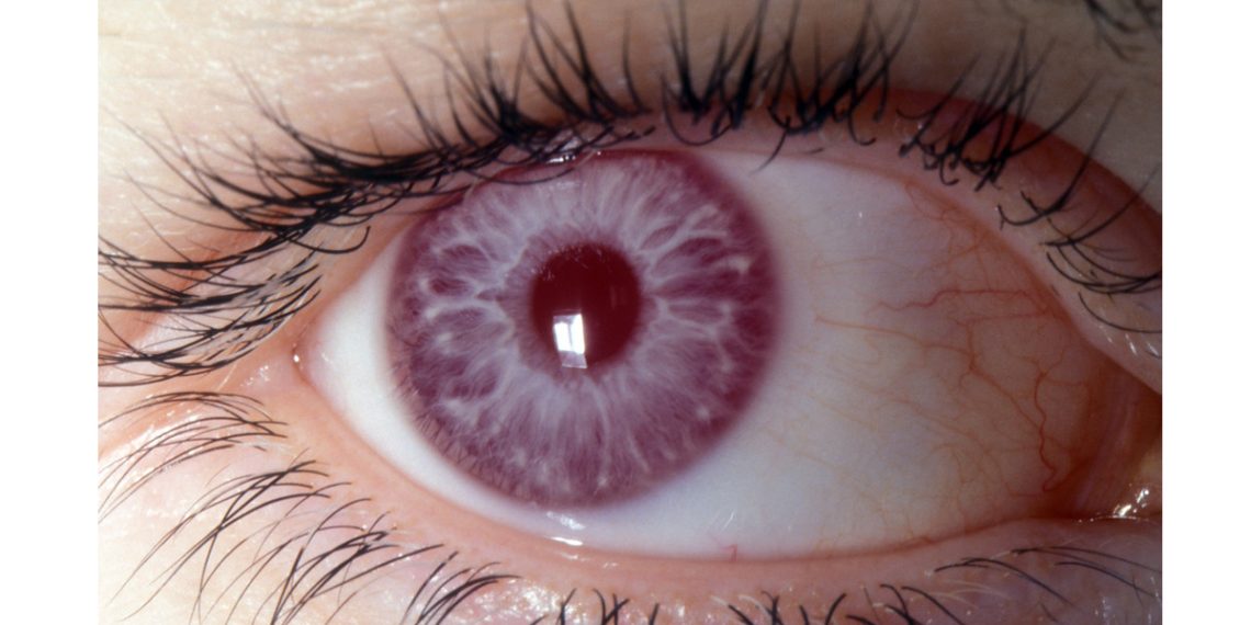 Diagnosis of Albinism