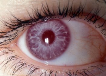 Diagnosis of Albinism