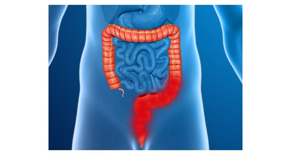 Diagnosis of Anal Cancer