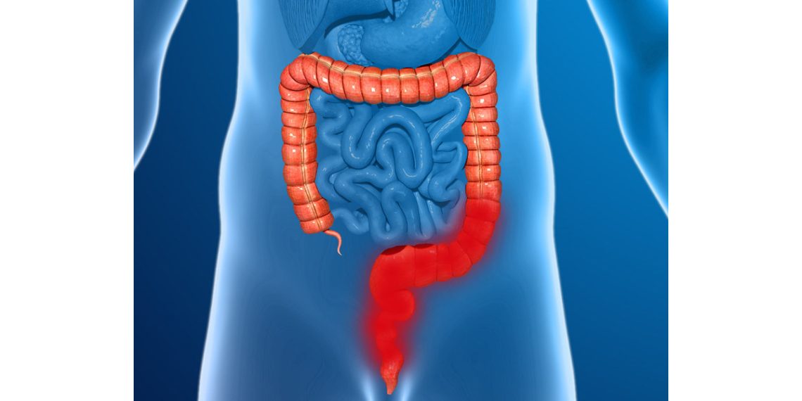 Diagnosis of Anal Cancer