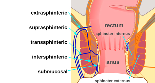 Diagnosis of Anal Fistula