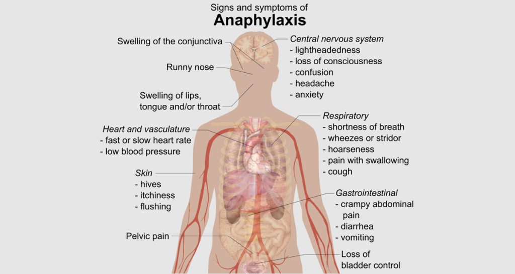 Diagnosis of Anaphylaxis