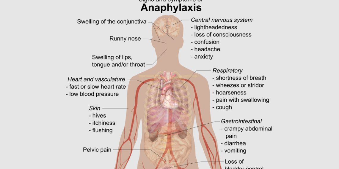 Diagnosis of Anaphylaxis