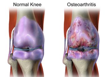 Diagnosis of Arthritis