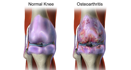 Diagnosis of Arthritis