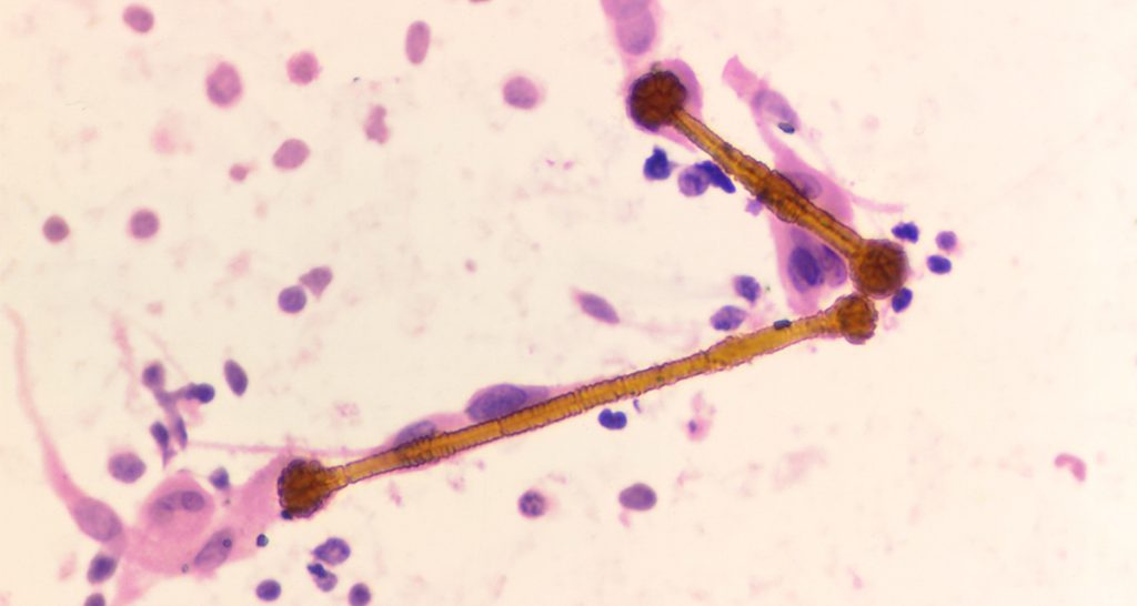 Diagnosis of Asbestosis