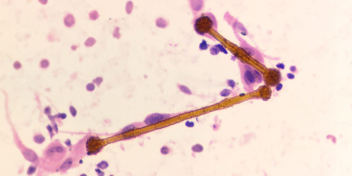 Diagnosis of Asbestosis