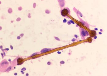 Diagnosis of Asbestosis